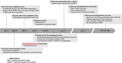 Rapid Progression to Complete Paraplegia After Electroacupuncture in a Patient With Spinal Dural Arteriovenous Fistula: A Case Report